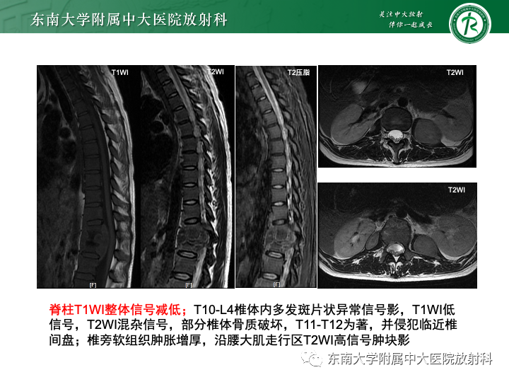 影像PPT - 【PPT】多发性骨髓瘤-32 影像PPT - 【PPT】多发性骨髓瘤-32