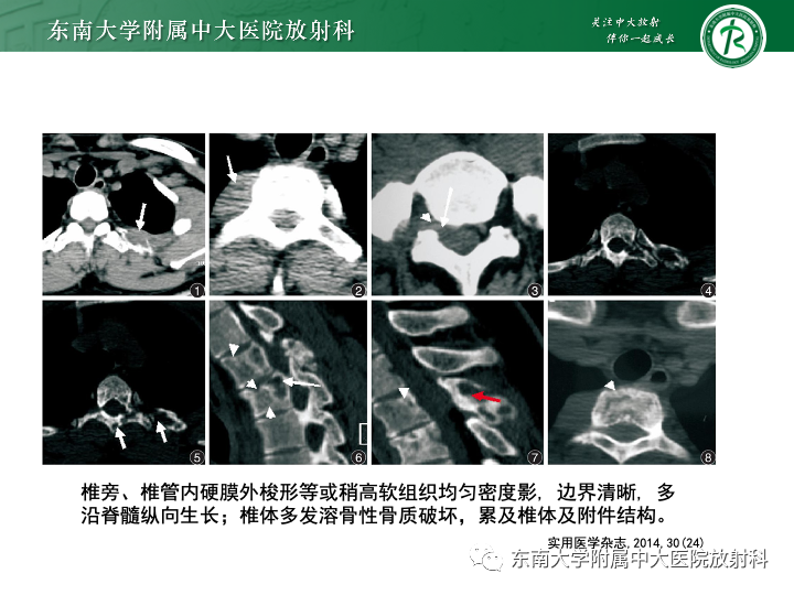 影像PPT - 【PPT】多发性骨髓瘤-35 影像PPT - 【PPT】多发性骨髓瘤-35