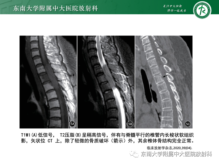 影像PPT - 【PPT】多发性骨髓瘤-36 影像PPT - 【PPT】多发性骨髓瘤-36