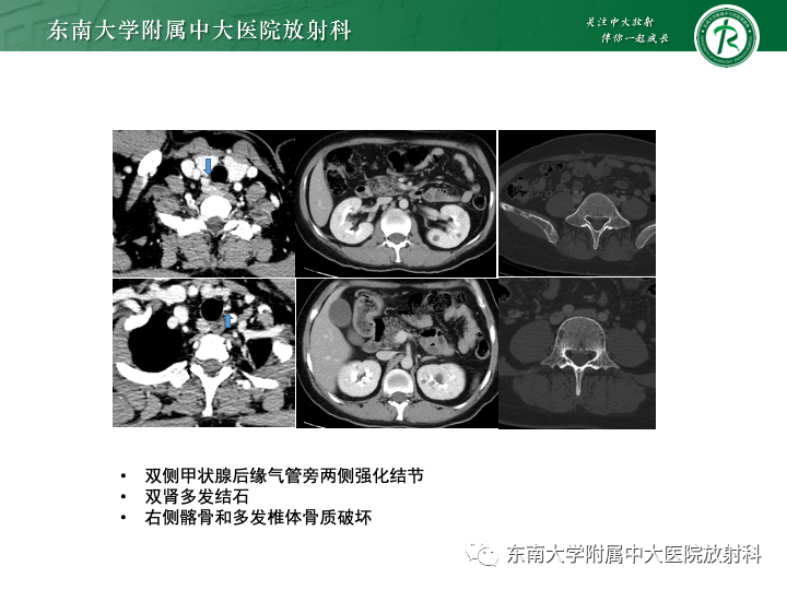 影像PPT - 【PPT】多发性骨髓瘤-38 影像PPT - 【PPT】多发性骨髓瘤-38