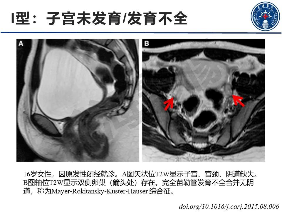 影像PPT - 【PPT】子宫畸形的分类及MR诊断-8