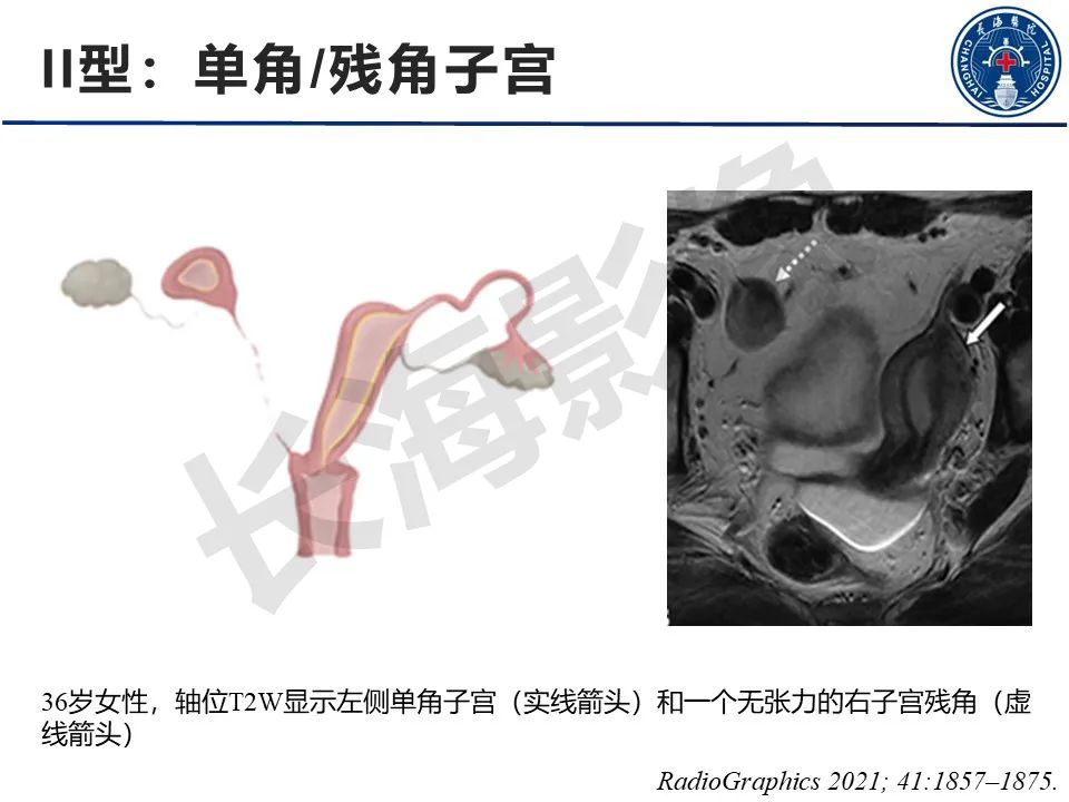 影像PPT - 【PPT】子宫畸形的分类及MR诊断-10