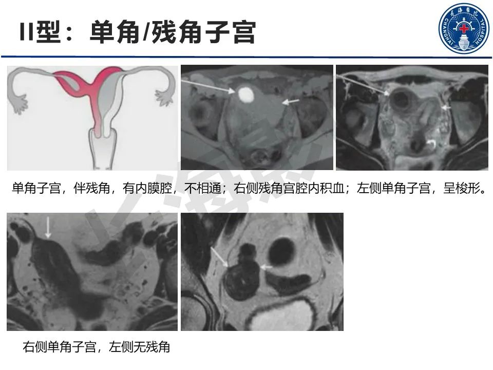 影像PPT - 【PPT】子宫畸形的分类及MR诊断-11