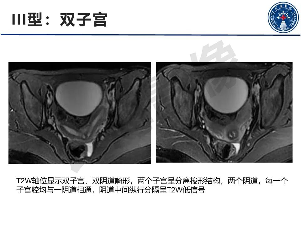 影像PPT - 【PPT】子宫畸形的分类及MR诊断-13