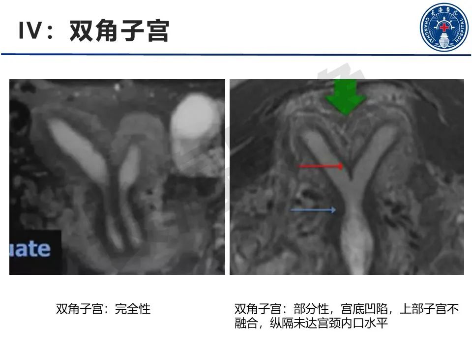 影像PPT - 【PPT】子宫畸形的分类及MR诊断-16