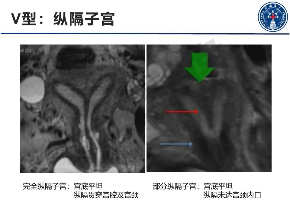 影像PPT - 【PPT】子宫畸形的分类及MR诊断-18