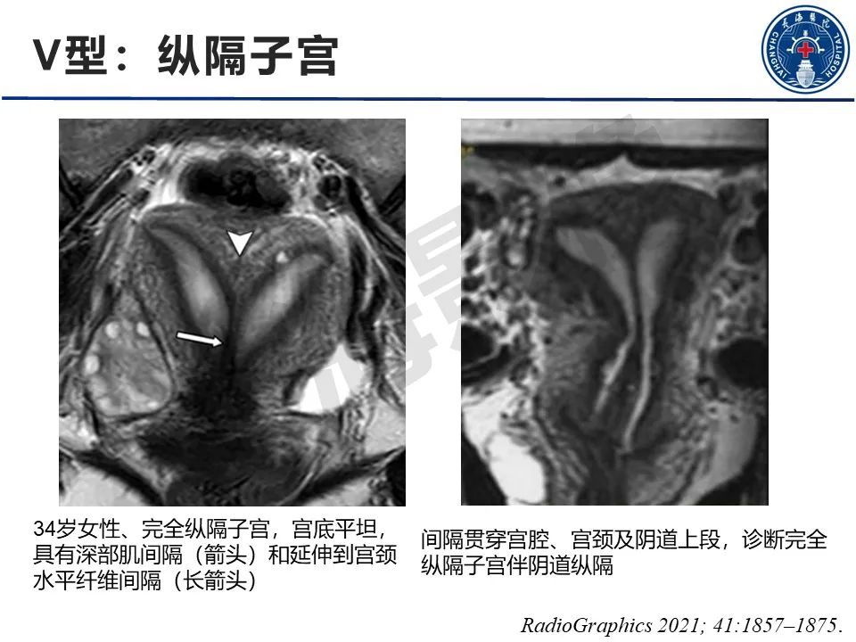 影像PPT - 【PPT】子宫畸形的分类及MR诊断-19