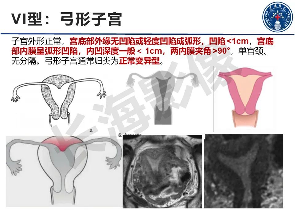 影像PPT - 【PPT】子宫畸形的分类及MR诊断-20
