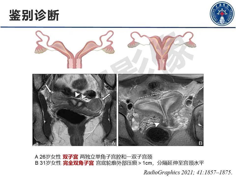 影像PPT - 【PPT】子宫畸形的分类及MR诊断-24
