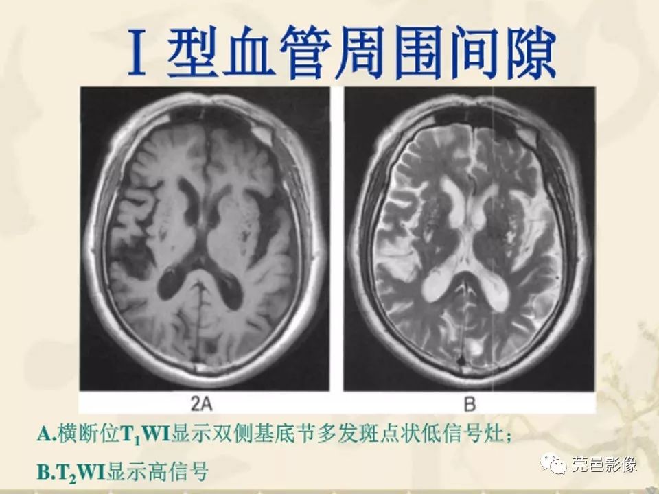 影像PPT - 【PPT】血管周围间隙（V-R间隙）影像诊断-19