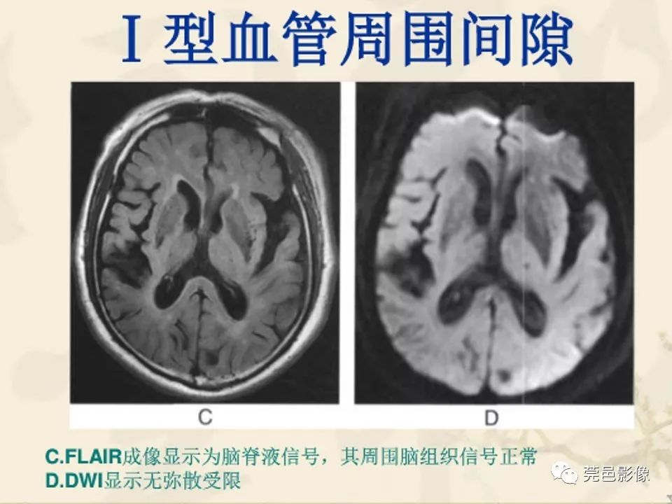 影像PPT - 【PPT】血管周围间隙（V-R间隙）影像诊断-20