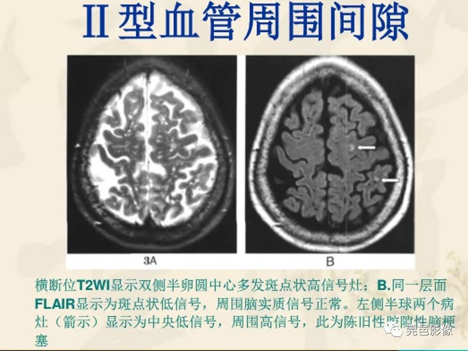 影像PPT - 【PPT】血管周围间隙（V-R间隙）影像诊断-30