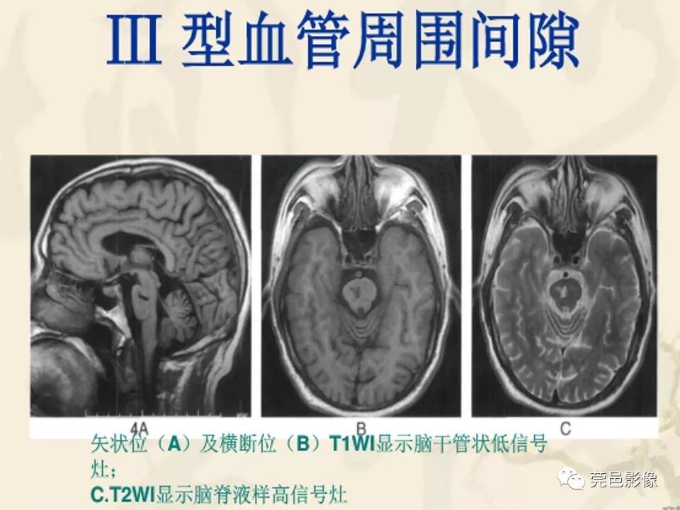 影像PPT - 【PPT】血管周围间隙（V-R间隙）影像诊断-41