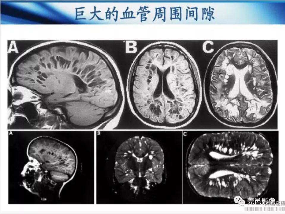 影像PPT - 【PPT】血管周围间隙（V-R间隙）影像诊断-43