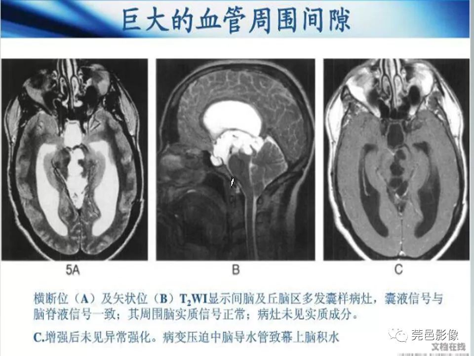 影像PPT - 【PPT】血管周围间隙（V-R间隙）影像诊断-44