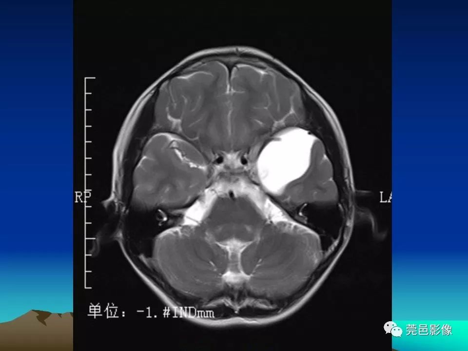 影像PPT - 【PPT】血管周围间隙（V-R间隙）影像诊断-63