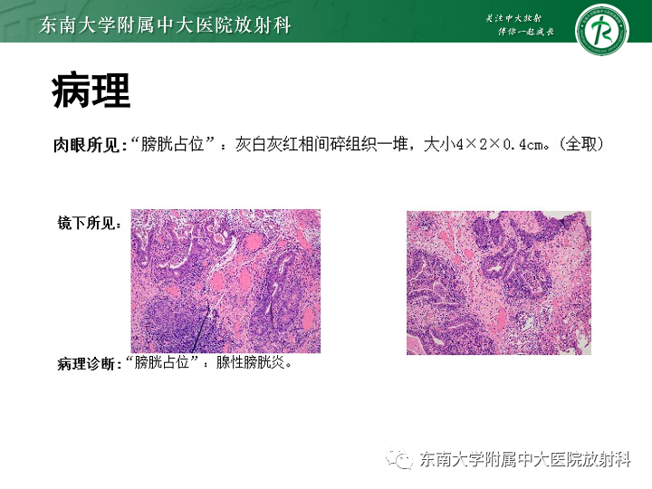 影像PPT - 【PPT】腺性膀胱炎-4 影像PPT - 【PPT】腺性膀胱炎-4