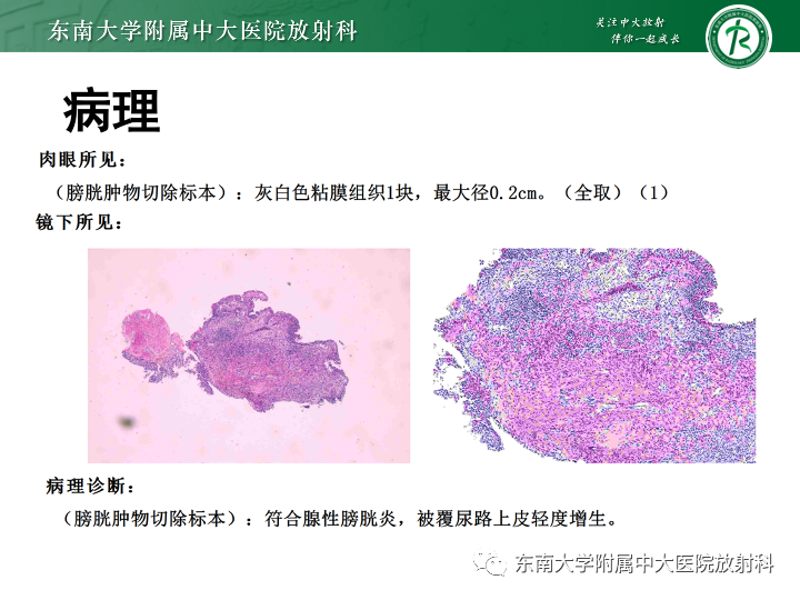 影像PPT - 【PPT】腺性膀胱炎-2 影像PPT - 【PPT】腺性膀胱炎-2