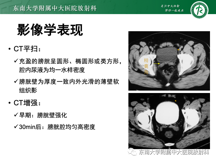 影像PPT - 【PPT】腺性膀胱炎-9 影像PPT - 【PPT】腺性膀胱炎-9
