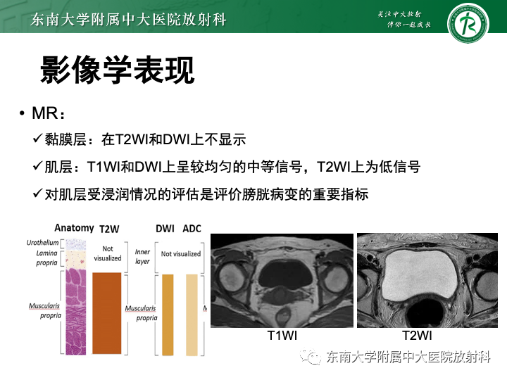 影像PPT - 【PPT】腺性膀胱炎-10 影像PPT - 【PPT】腺性膀胱炎-10