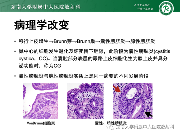 影像PPT - 【PPT】腺性膀胱炎-12 影像PPT - 【PPT】腺性膀胱炎-12