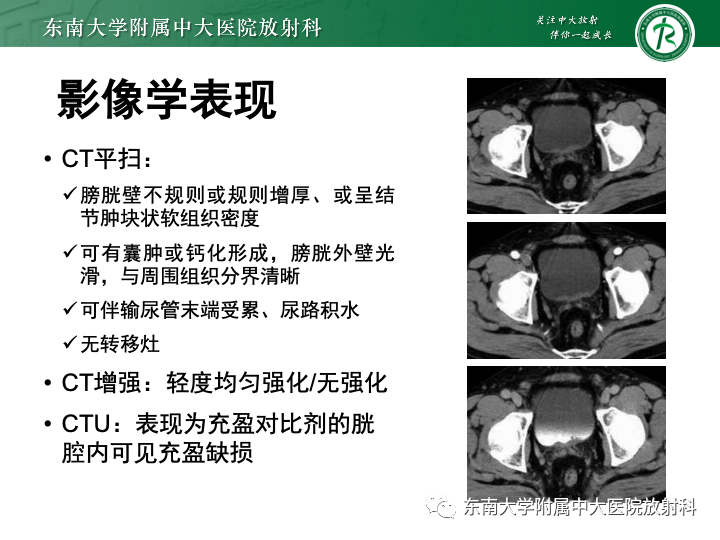 影像PPT - 【PPT】腺性膀胱炎-16 影像PPT - 【PPT】腺性膀胱炎-16