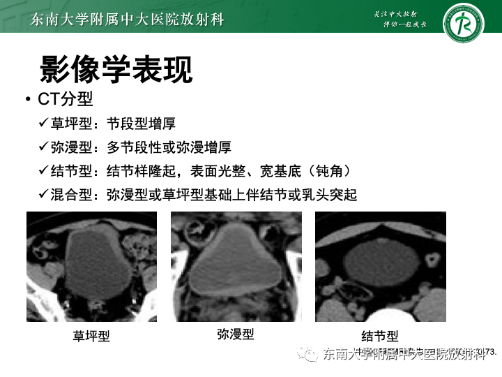 影像PPT - 【PPT】腺性膀胱炎-17 影像PPT - 【PPT】腺性膀胱炎-17