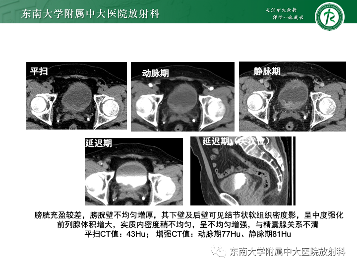 影像PPT - 【PPT】腺性膀胱炎-24 影像PPT - 【PPT】腺性膀胱炎-24