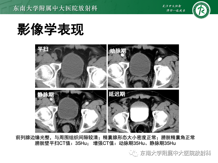 影像PPT - 【PPT】腺性膀胱炎-28 影像PPT - 【PPT】腺性膀胱炎-28