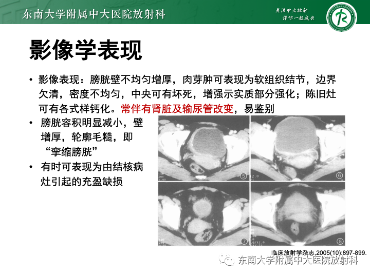影像PPT - 【PPT】腺性膀胱炎-30 影像PPT - 【PPT】腺性膀胱炎-30