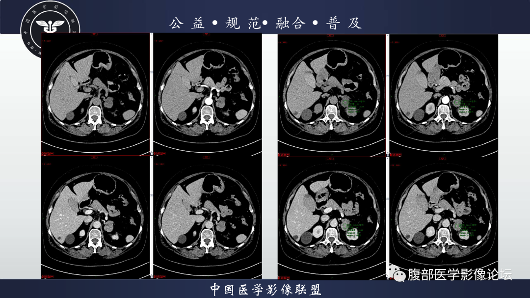 影像PPT - 【病例】肾脏透明细胞癌1例CT影像-4