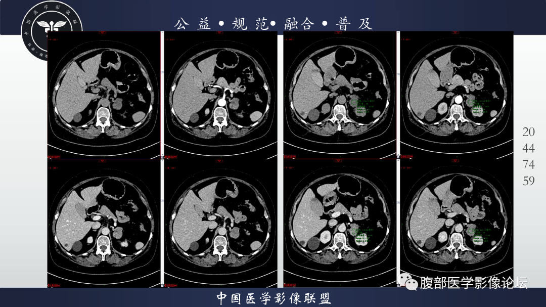 影像PPT - 【病例】肾脏透明细胞癌1例CT影像-5