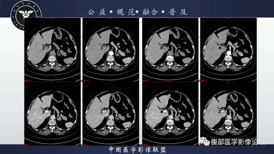 影像PPT - 【病例】肾脏透明细胞癌1例CT影像-3