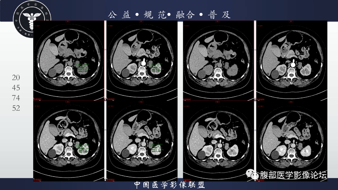 影像PPT - 【病例】肾脏透明细胞癌1例CT影像-6
