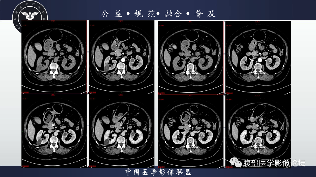 影像PPT - 【病例】肾脏透明细胞癌1例CT影像-7