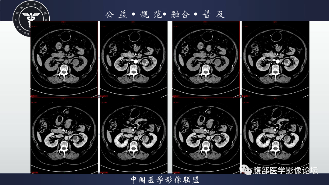 影像PPT - 【病例】肾脏透明细胞癌1例CT影像-8