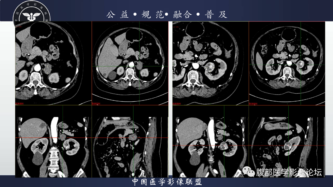 影像PPT - 【病例】肾脏透明细胞癌1例CT影像-9