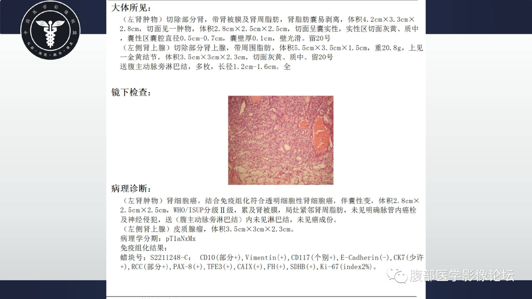 影像PPT - 【病例】肾脏透明细胞癌1例CT影像-10