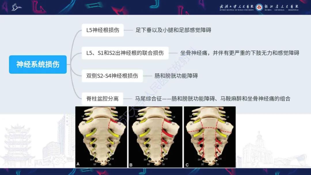 影像PPT - 【PPT】骶骨骨折CT评估-6