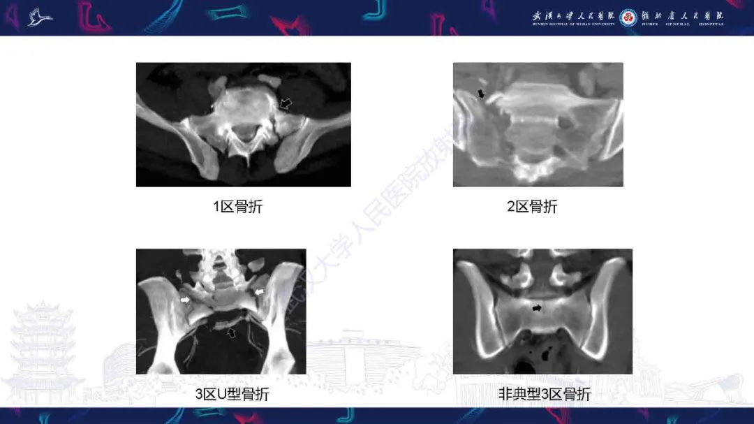 影像PPT - 【PPT】骶骨骨折CT评估-11
