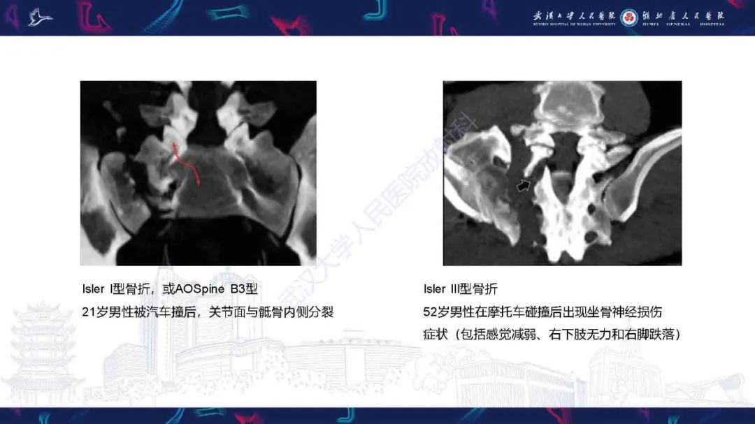 影像PPT - 【PPT】骶骨骨折CT评估-16