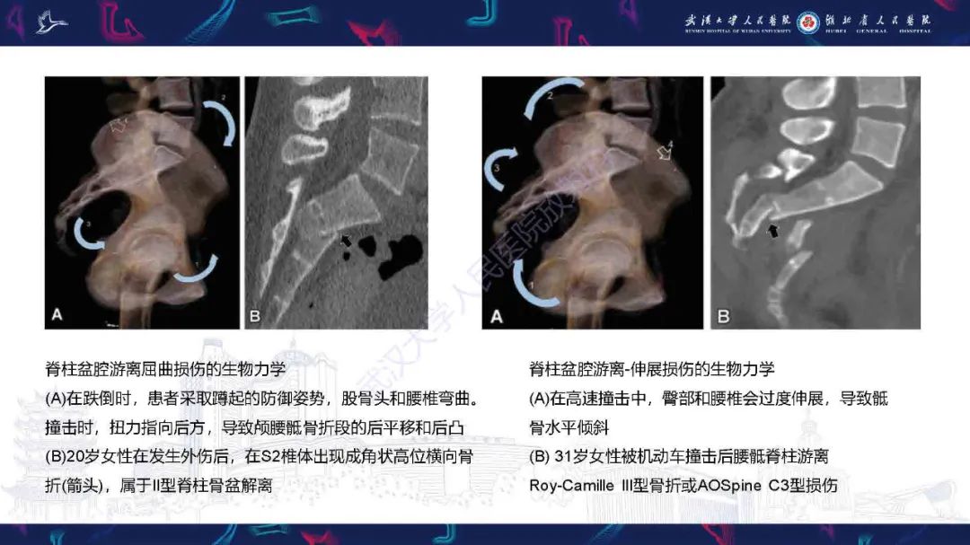 影像PPT - 【PPT】骶骨骨折CT评估-14