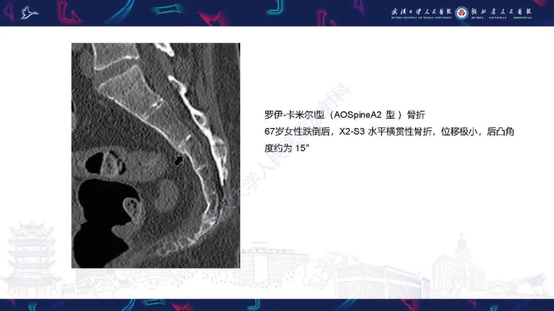 影像PPT - 【PPT】骶骨骨折CT评估-13