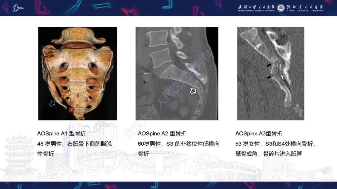 影像PPT - 【PPT】骶骨骨折CT评估-19