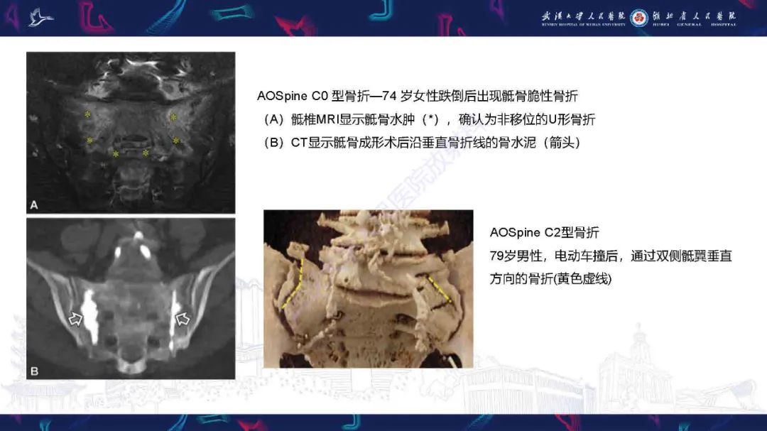 影像PPT - 【PPT】骶骨骨折CT评估-20