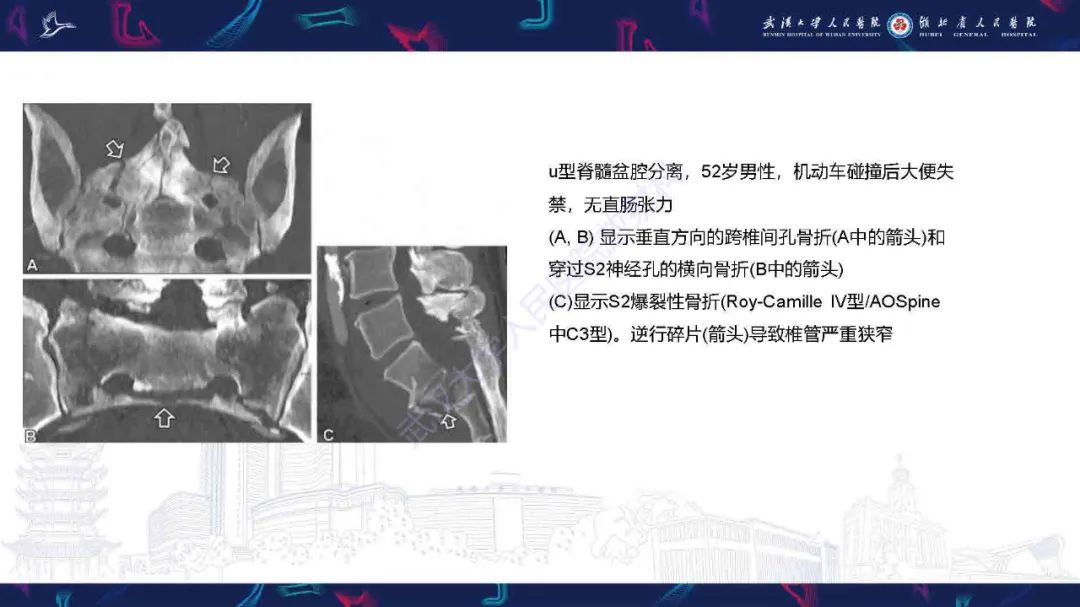 影像PPT - 【PPT】骶骨骨折CT评估-21