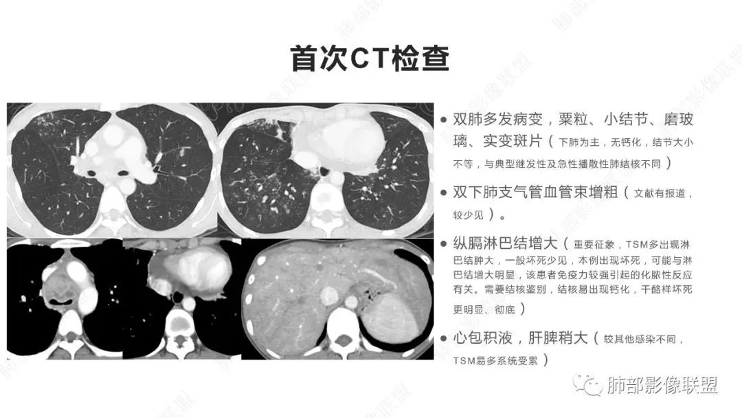 影像PPT - 【PPT】马尔尼菲篮状菌的CT表现-3 影像PPT - 【PPT】马尔尼菲篮状菌的CT表现-3
