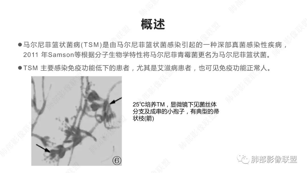 影像PPT - 【PPT】马尔尼菲篮状菌的CT表现-5 影像PPT - 【PPT】马尔尼菲篮状菌的CT表现-5