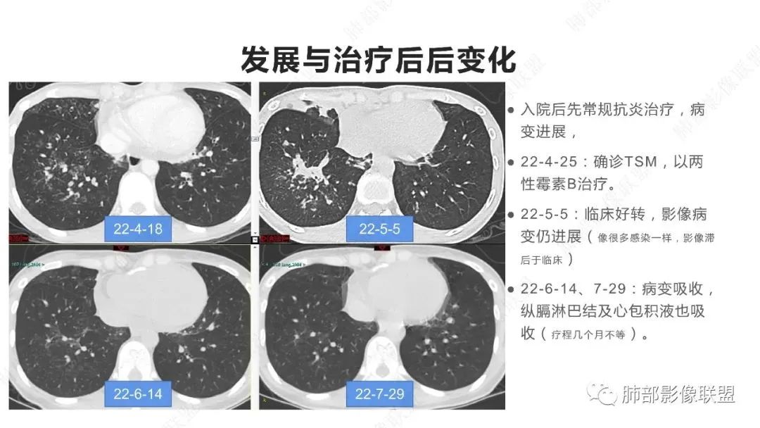 影像PPT - 【PPT】马尔尼菲篮状菌的CT表现-4 影像PPT - 【PPT】马尔尼菲篮状菌的CT表现-4