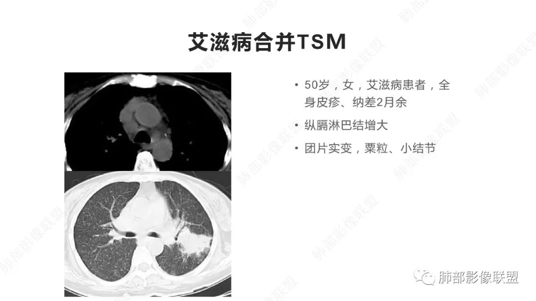 影像PPT - 【PPT】马尔尼菲篮状菌的CT表现-9 影像PPT - 【PPT】马尔尼菲篮状菌的CT表现-9